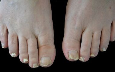 Comment se débarrasser du champignon sur les doigts