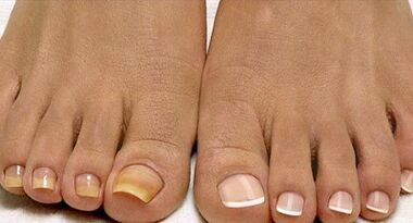 Champignons du traitement des champignons de la flotte