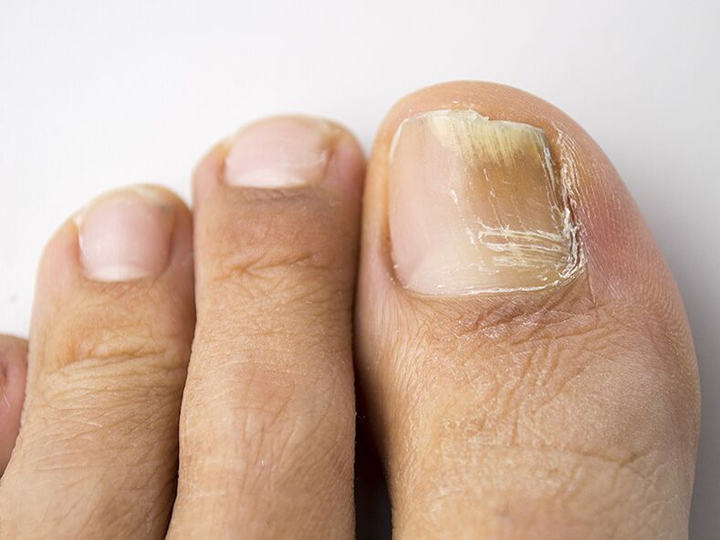 La phase initiale du champignon