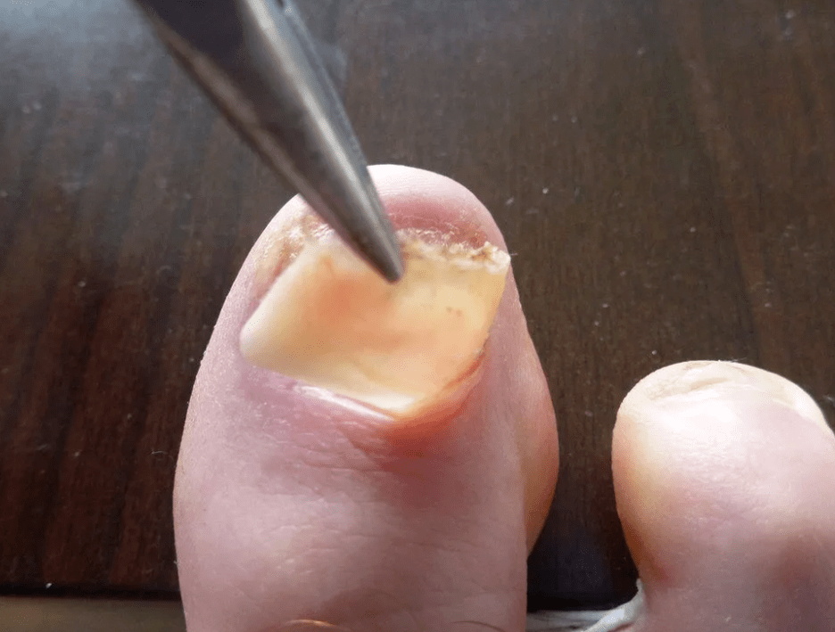 retrait de la plaque