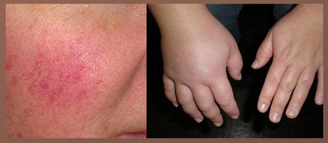 Effets secondaires des gouttes