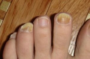 jaunissement de l'ongle dû à des champignons