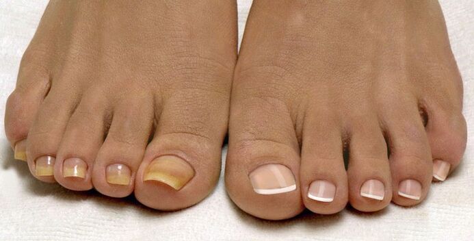 Mycose des ongles sur un pied