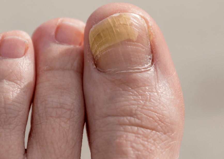Champignon sur l'ongle du gros orteil.