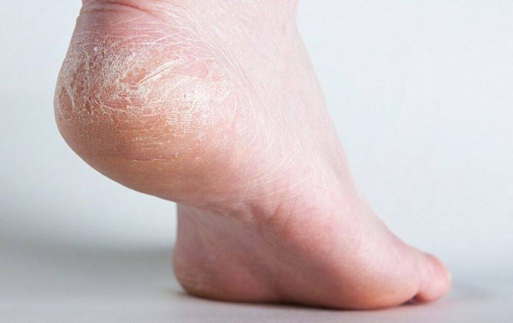 Champignon sur la peau des pieds.